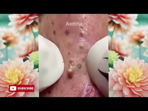 Relax squeezing out blackheads 52 Черные точки