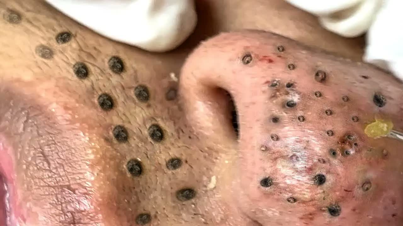 Relax squeezing out blackheads 33 Черные точки