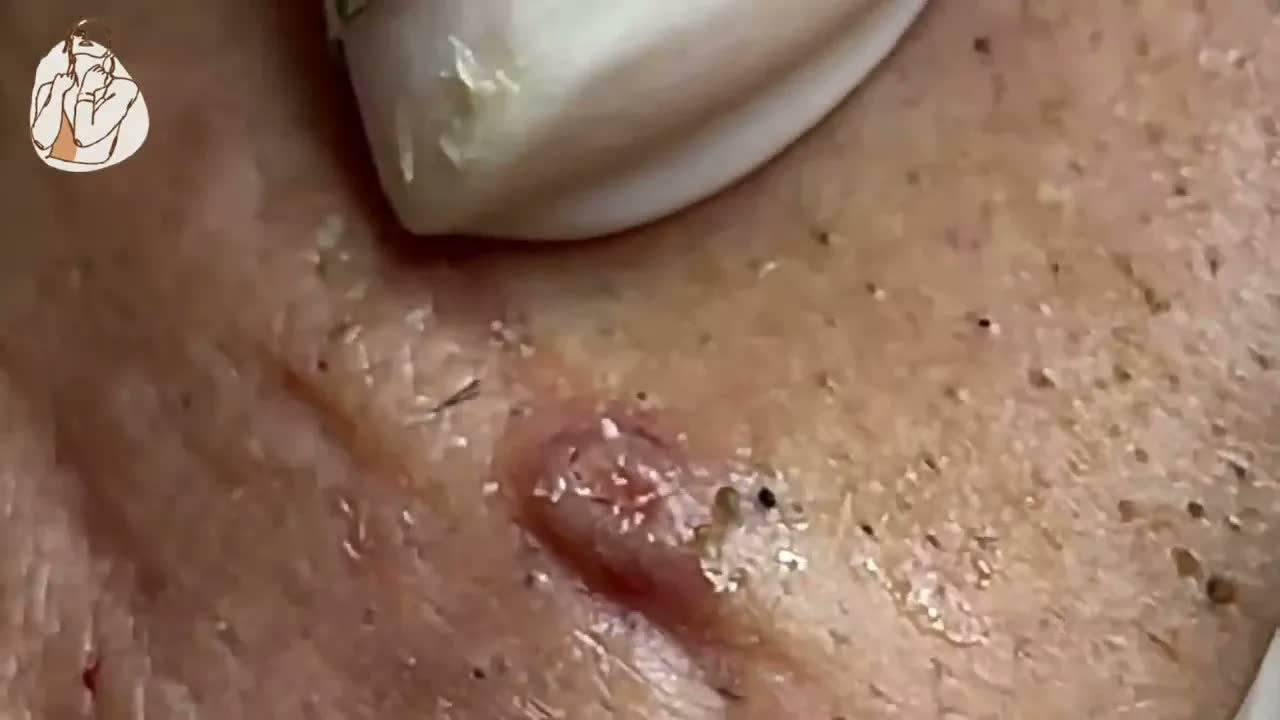 Relax squeezing out blackheads 60 Черные точки