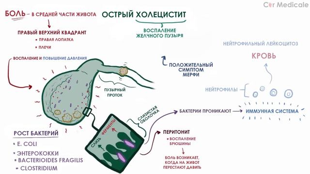 Острый холецистит - краткий обзор патогенеза