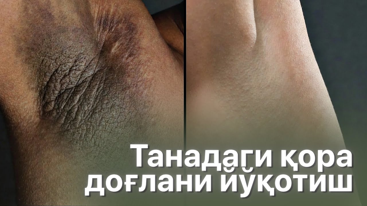 Танада қора доғлар нега пайдо бўлади ва улардан қандай қутулиш мумкин?