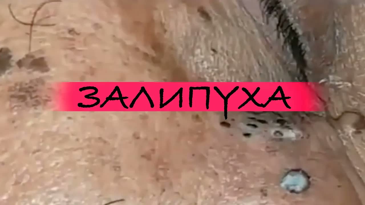БОЛЬШИЕ ЖИРНЫЕ ПРЫЩИ НА ЛИЦЕ. ПРЫЩИ ВЫДАВЛИВАНИЕ. ЛЕЧЕНИЕ АКНЕ НА ЛИЦЕ. ПРЫЩИ ASMR. RELAX ACNE