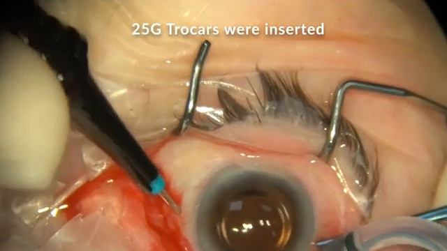 Epiretinal Membrane Surgery (Combined Phaco + IOL + CTR + PPV + Peel)