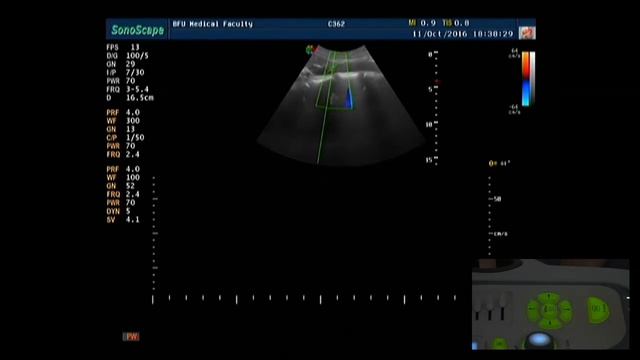 Практическое занятие:  Допплерография брюшной аорты