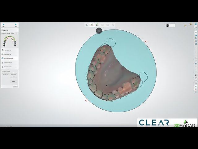 Создание mock-up с использованием 3Shape Dental System