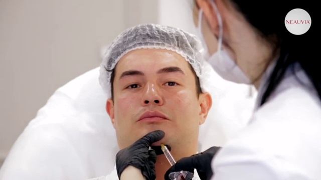 Коррекция мужского подбородка Neauvia Intense