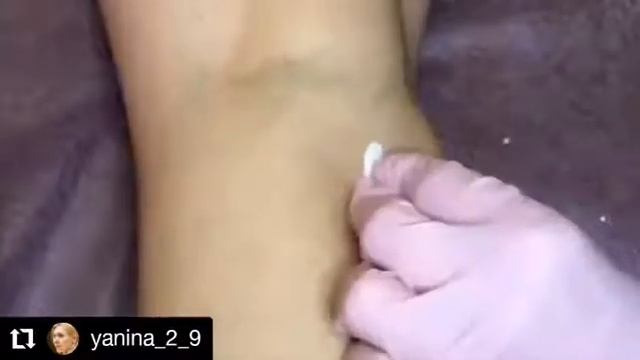 Склеротерапия телеангиоэктазий и ретикулярных вен