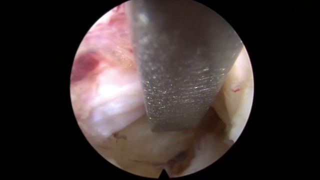 Интерламинарная эндоскопическая дискэктомия (Interlaminar Full-endoscopic Discectomy) L5/S1