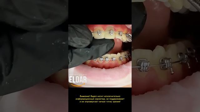 БРЕКЕТЫ H4 как легко открыть?