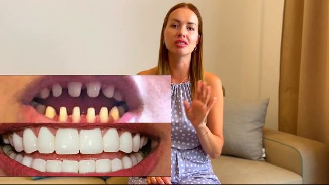 СДЕЛАЛА ЗУБЫ В ТУРЦИИ ЗА 9 ДНЕЙ/ СКОЛЬКО СТОЯТ ВИНИРЫ?