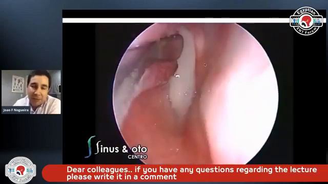 Management Of Choanal Atresia-  Prof. Flavio Nogueira
