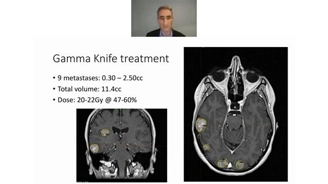 Life-Changing Gamma Knife Treatment: A Patient Review by Kris Hallenga
