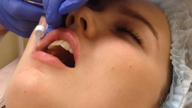 АирисКом студенты учатся: увлажнение легким филлером. Губы до 30 лет.