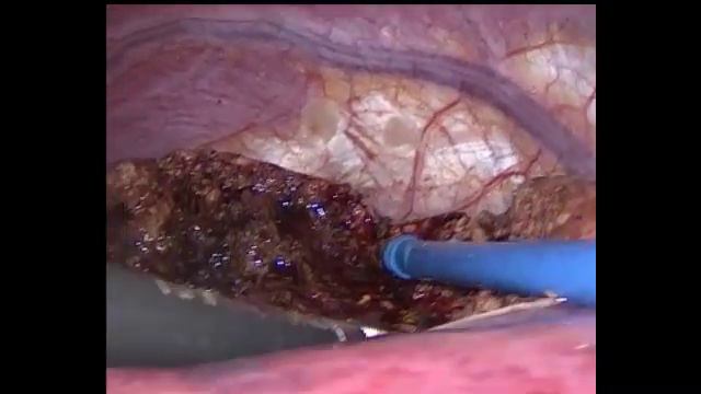 Лапароскопическая  резекция печени  S7