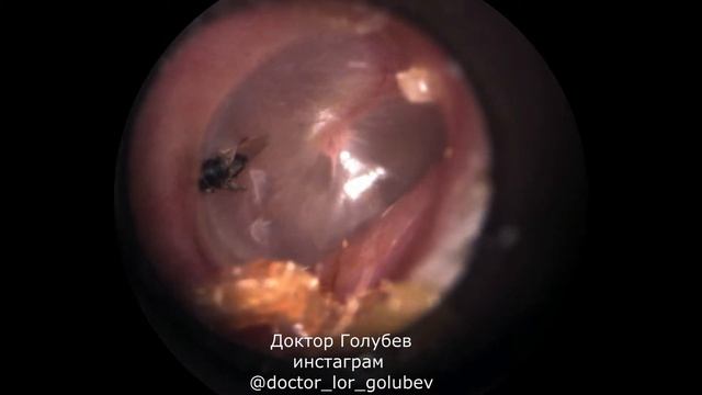 насекомое в ухе!