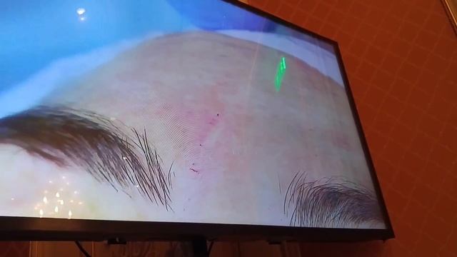 Бланшинг. Belotero.