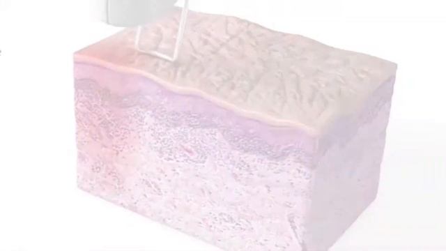 Лазерное омоложение в Way Woman Клуб лазерной системой  Quanta System Duetto