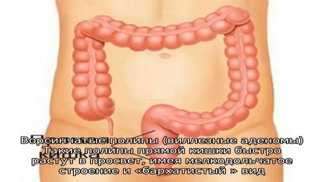 Лечение полипов прямой кишки