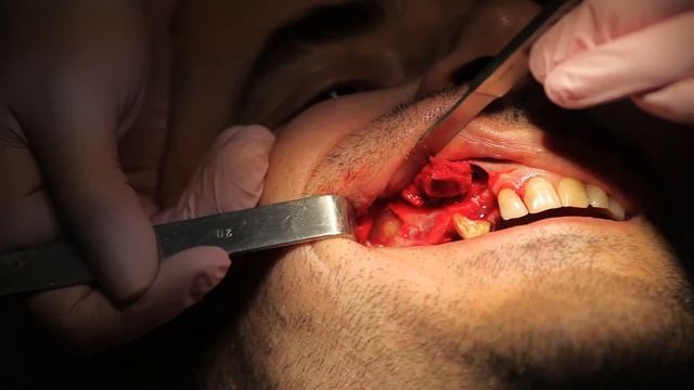 Sinus Lift,split Crest,prf, Dental Implants