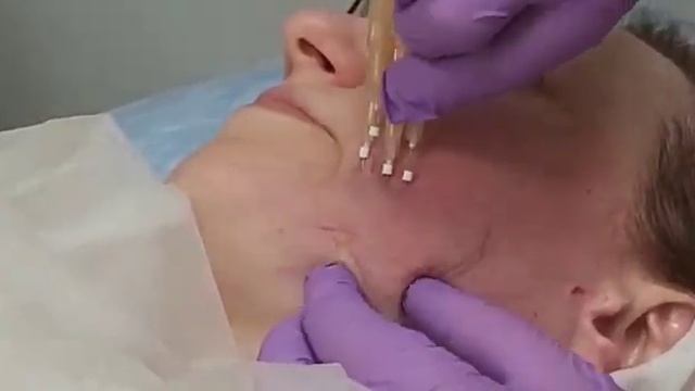 АирисКом студенты учатся: повышение квалификации по мезонитям (коги, спираль, насечки)