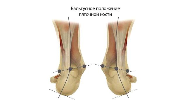 Плоскостопие. Почему появляется и что делать? / Александр Колдаев