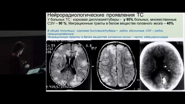 Ангиомиолипомы почек ассоциированные с туберозным склерозом  Диагностические критерии
