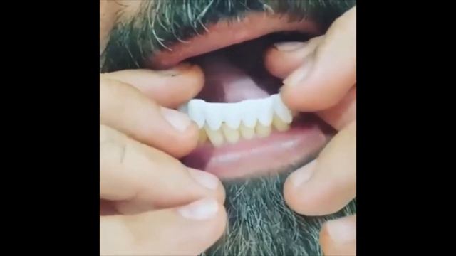 Накладные зубные Виниры!