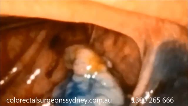 Endoscopic Mucosal Resection EMR Of Polyps - Chinese Simplified