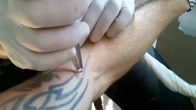 Удаление Tatoo лазером.wmv
