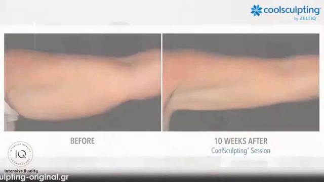 CoolSculpting криолиполиз