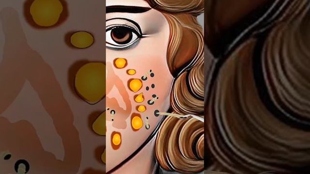 Remove Huge Worms From Face Asmr #asmr