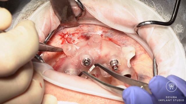 All On 4 / Sinus-lifting/ Dziuba Implant Studio