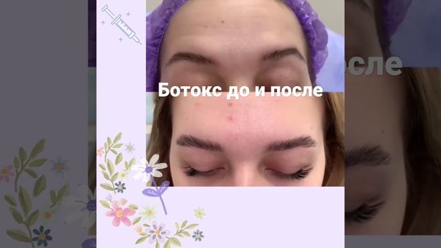 Ботокс лоб и между бровей. До и после