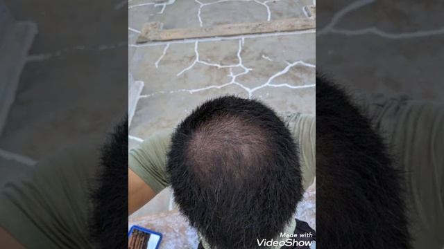 Minoxidil 5%, Finasteride 1mg & Derma Roller 1.0mm , 3 Month Hair Grow Result