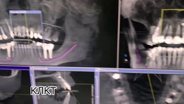 Одномоментная имплантация | Как устанавливают импланты | имплантация зубов