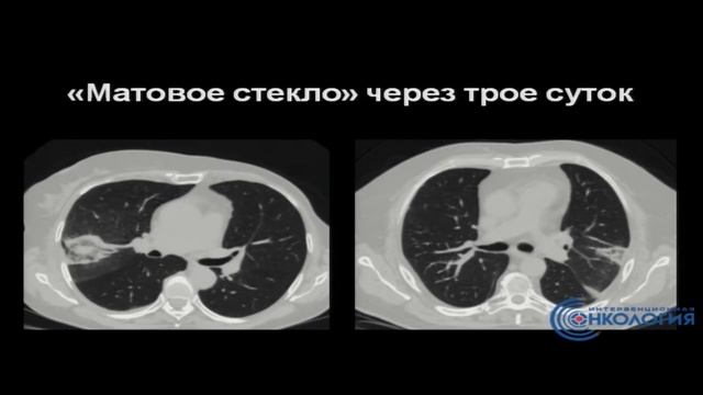 Радіочастотна абляція злоякісних новоутворень легень