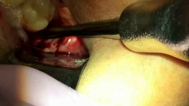 Impacted Wisdom Teeth Extraction Surgery With Tips And Tricks. Also An Awesome Song To Go With It!!