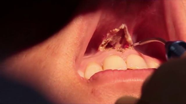 13 Хирургия уздечки