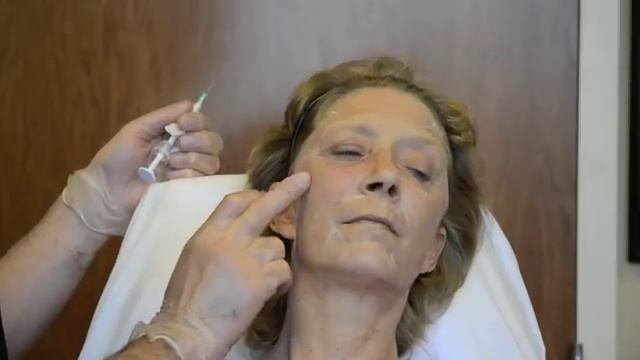 Full Face Correction With Radiesse Volumizing Filler Featuring Dr. Joseph Campanelli
