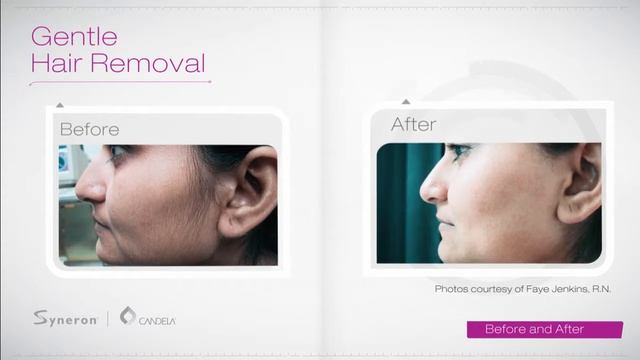 Laser Hair Removal Video | Full Length Patient Video