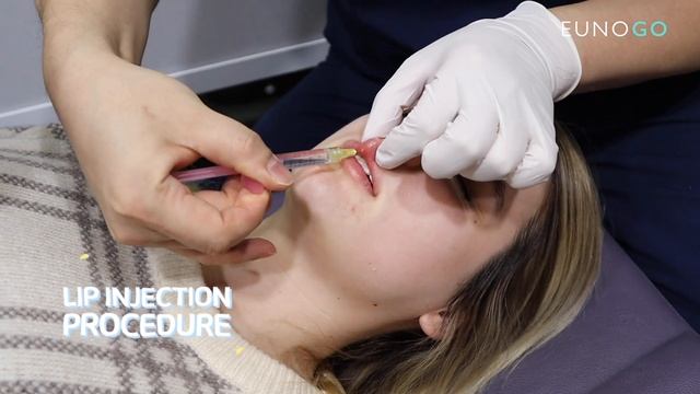 Natural Looking and Fuller Lips with Korean Lip Fillers  Step by Step Before and After