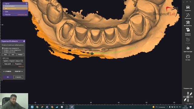 виниры в exocad. Моделирование от А до Я. Зубы в цифре. Модель для печати. 3D модель.