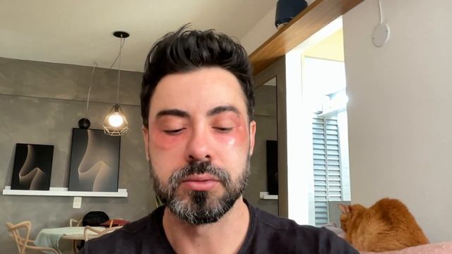 Peeling De Fenol - Line Skin 26º Dia - Dr. Hugo Andrade