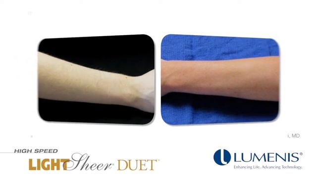 LightSheer Duet Video