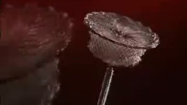 Amplatzer Duct Occluder