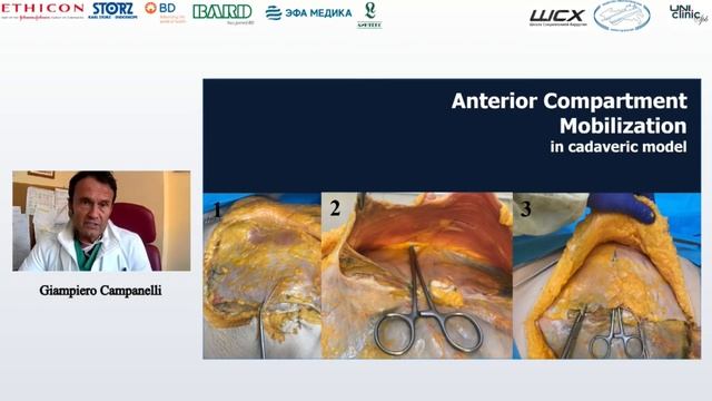 Перспективы хирурга при диастазе. Campanelli G