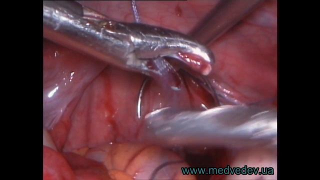 Кольпопоез по Давыдову