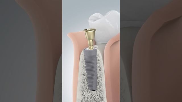 Имплантация зубов это больно? #shorts