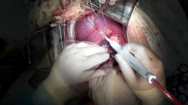 резекция IV сегмента печени