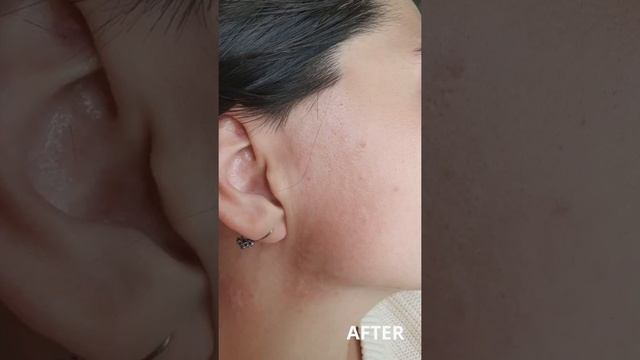 Электроэпиляция (видео №1)